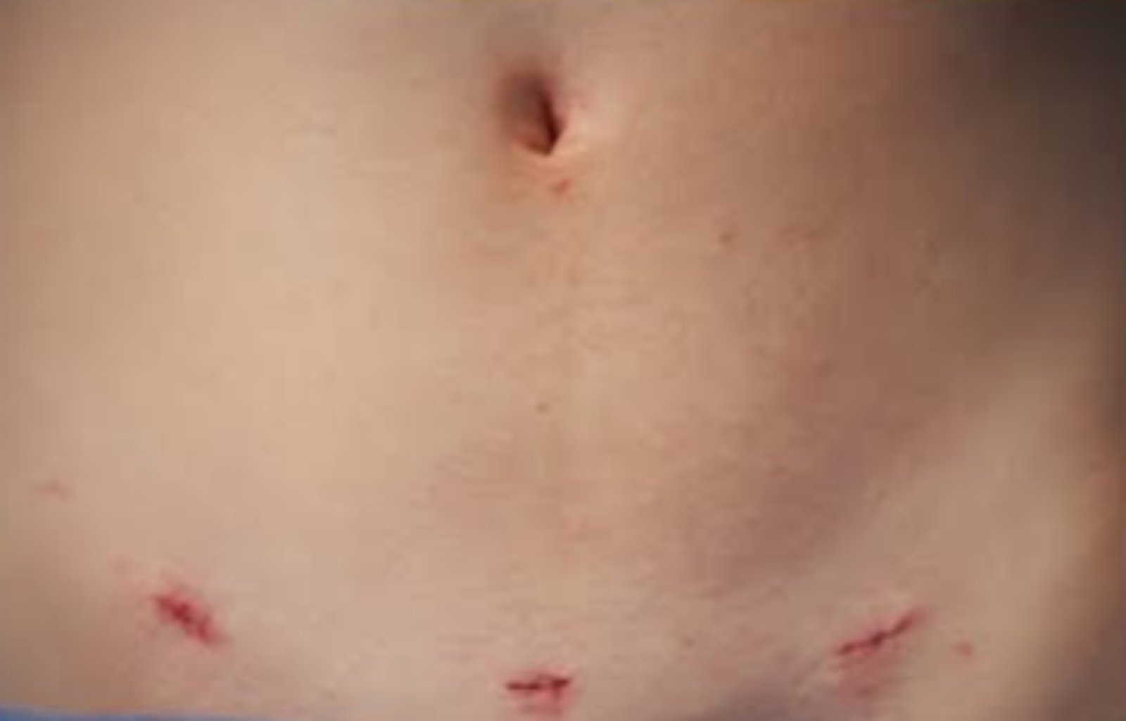 Marcas dos três furinhos da cirurgia de vesícula na parte baixa do abdome, abaixo da linha do biquíni
